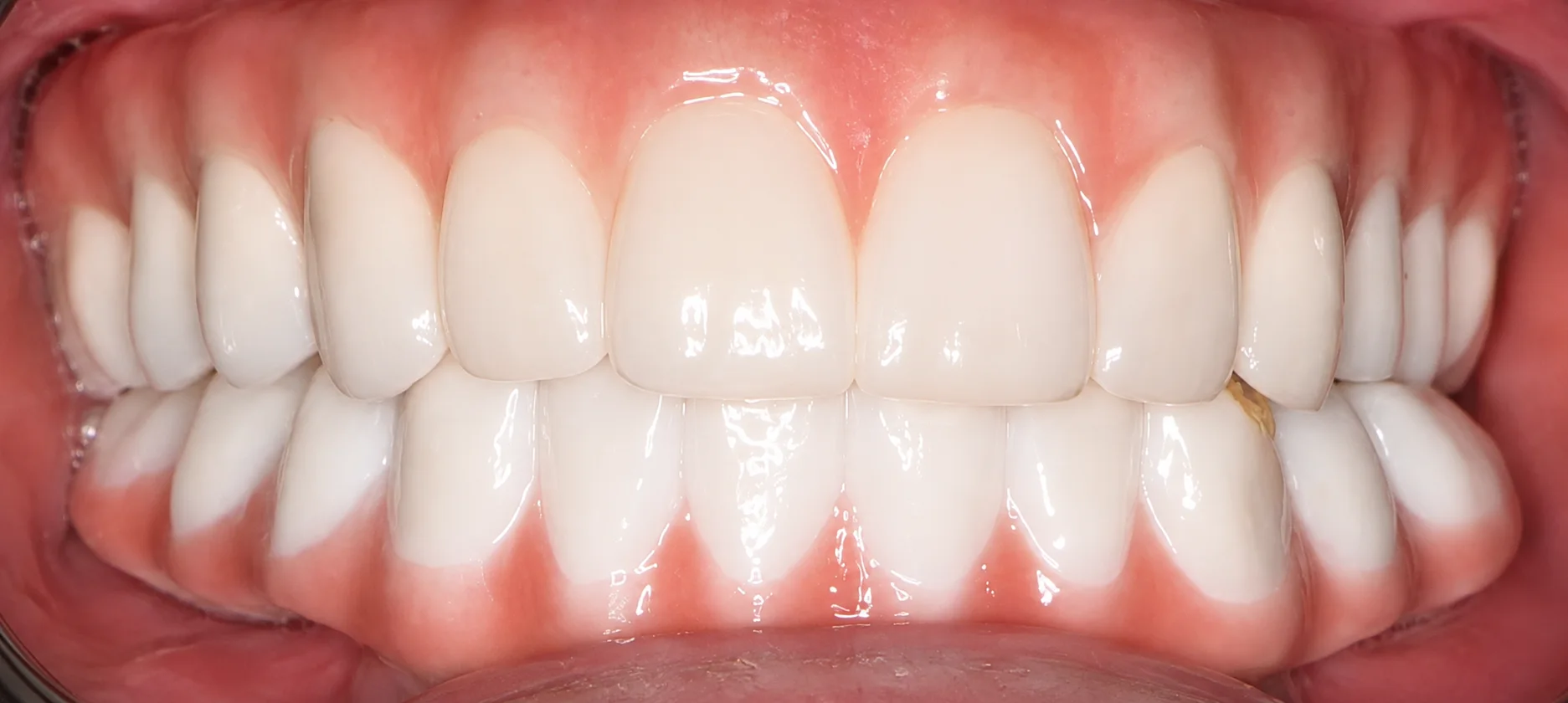 Final All-on-X treatment result at Laguna Dental and Orthodontics