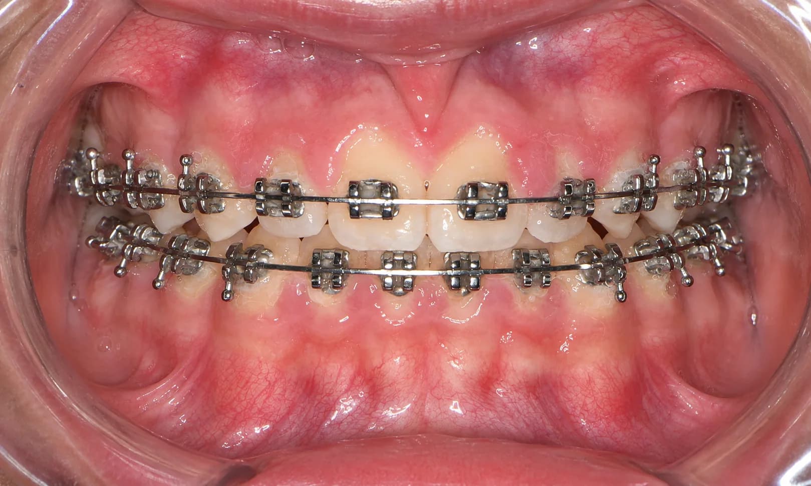 Close-up of metal braces during orthodontic treatment